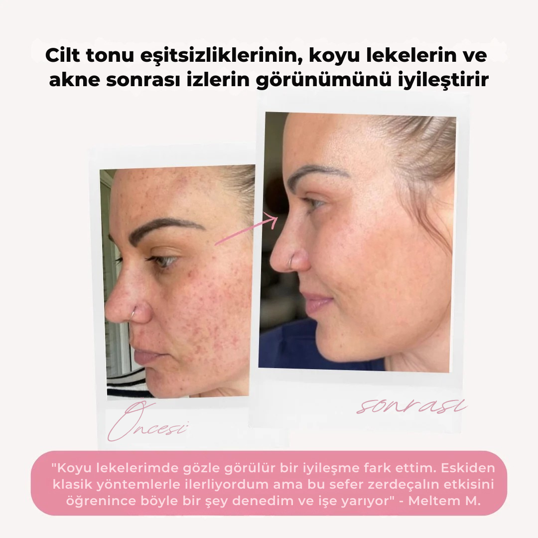 Leke ve Akne Karşıtı %100 Doğal Yüz Temizleme Pedi